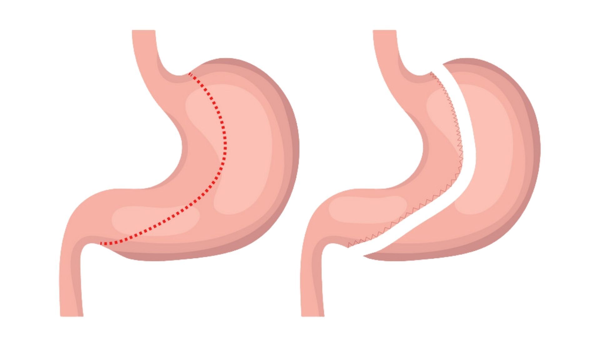 Gastric Sleeve: Understanding Risks and Complications